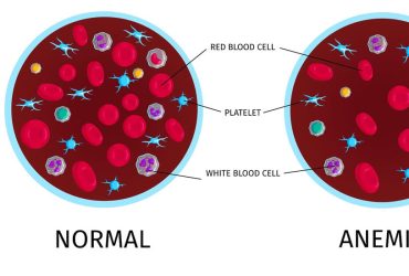ce este anemia